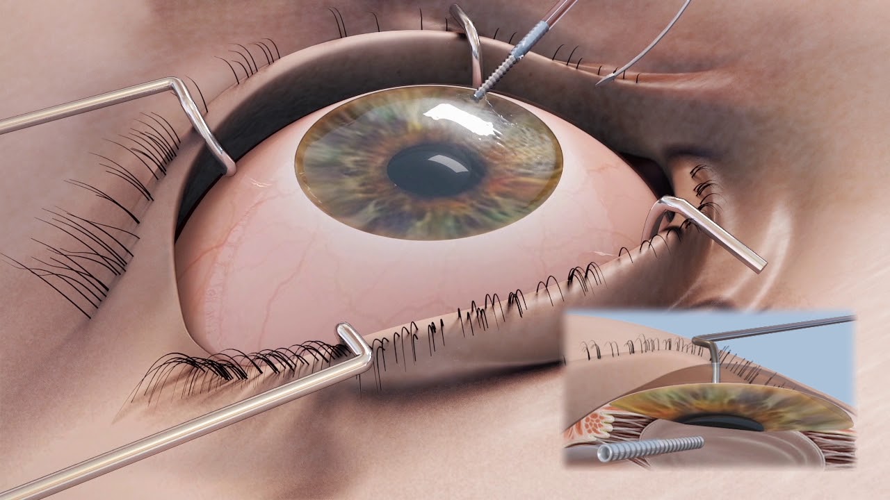 Corneal Surgery