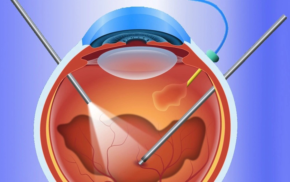 Vitreoretinal (Surgical & Injection)