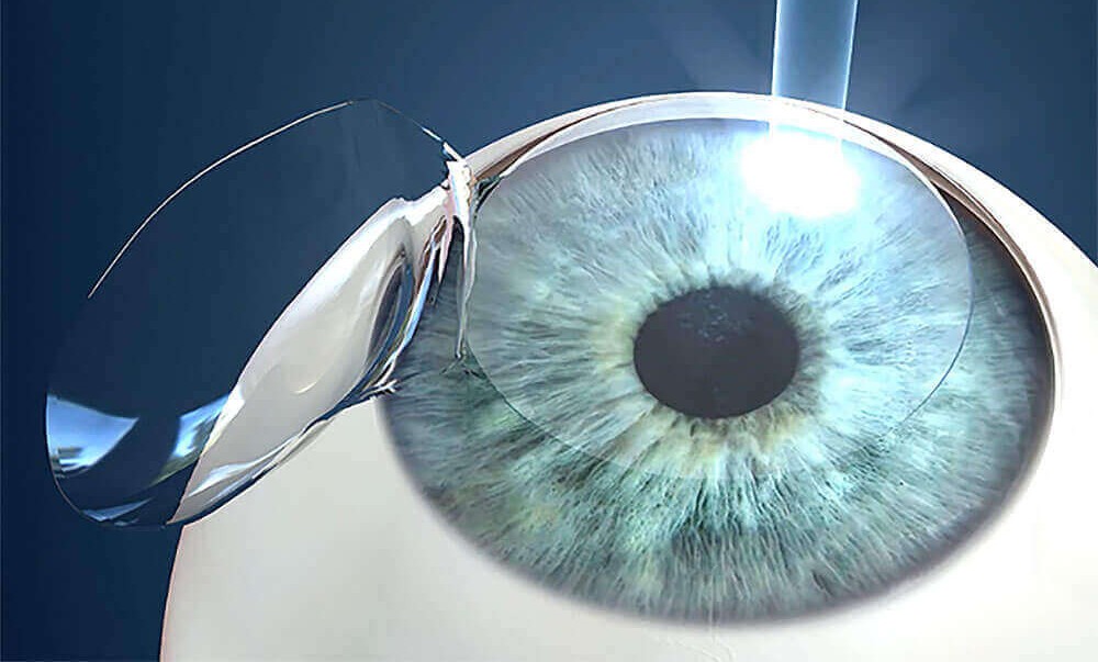 Refractive ( lasik , Femtolasik  FemtoSmile , Smile Pro , ICL )